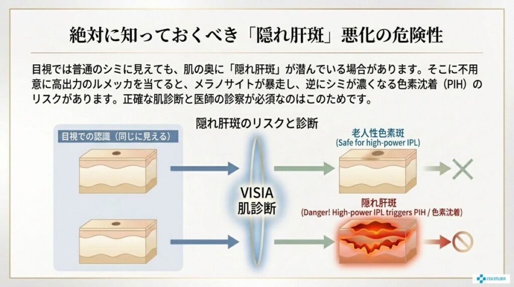 IPL治療・ルメッカの副作用リスクと肝斑悪化の危険性(色素沈着/PIH)