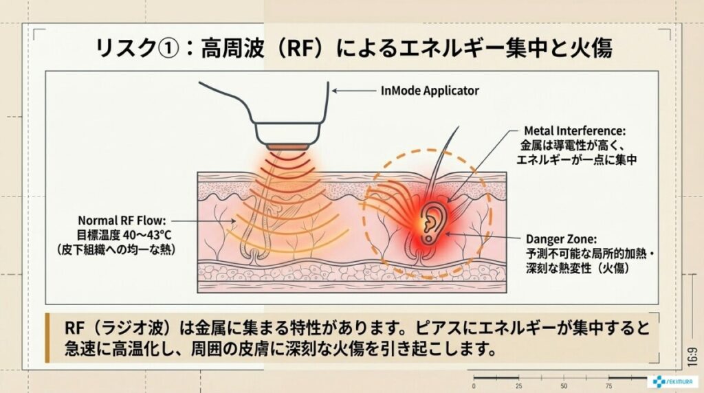 RF(高周波)による電流集中と熱損傷(火傷)リスク
