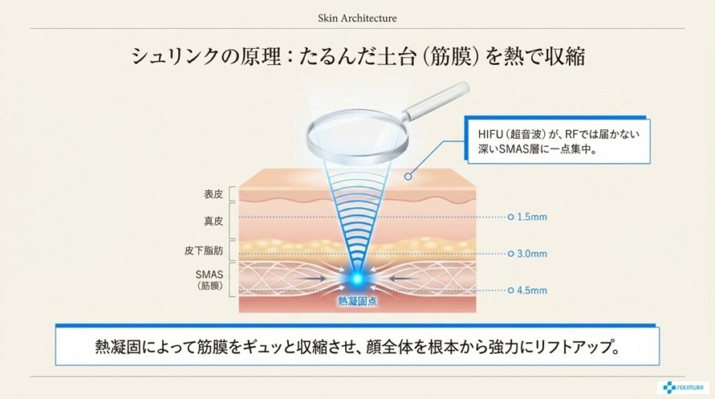 SMAS層(筋膜層)から引き上げる「シュリンク」の原理